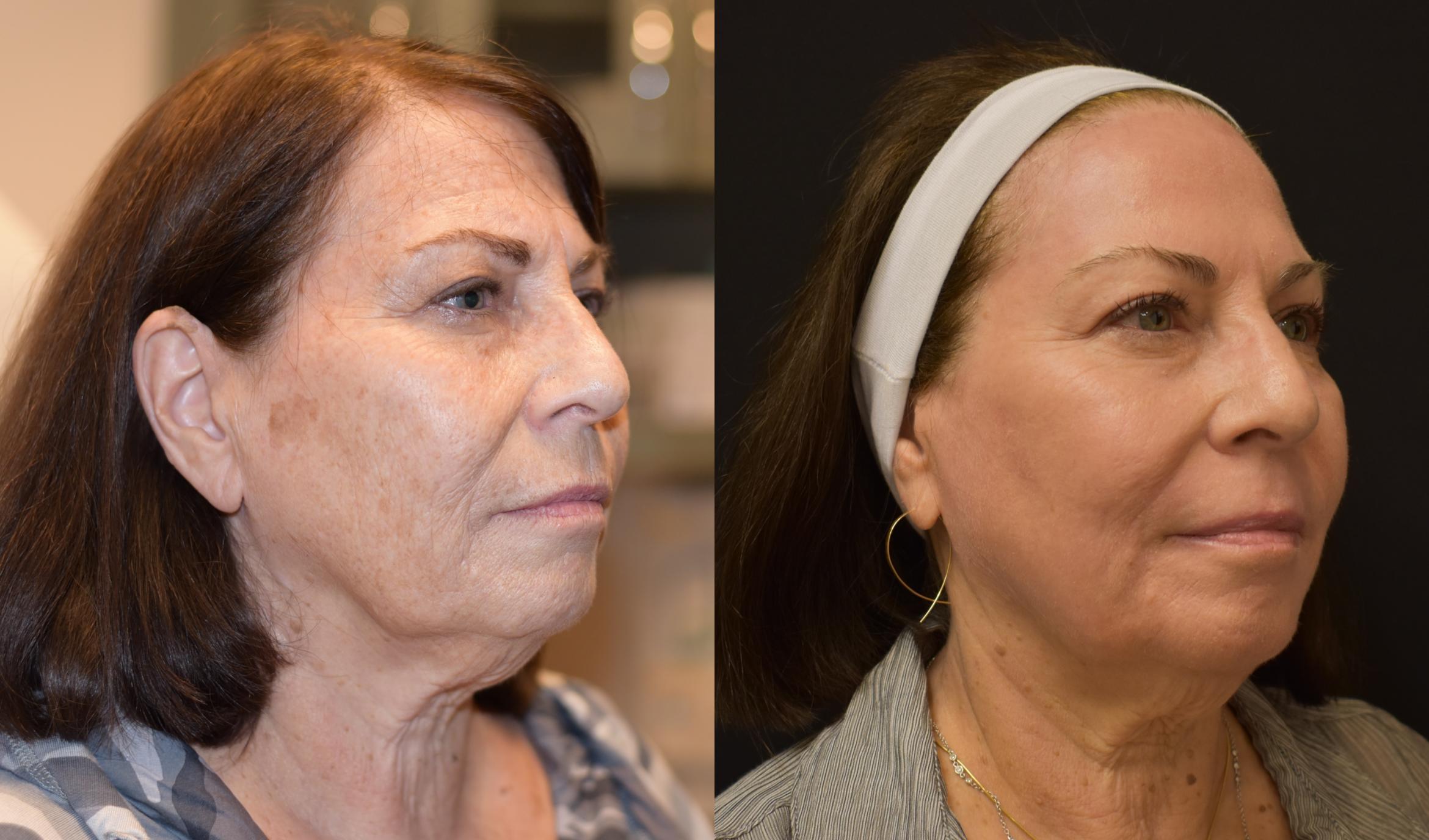 Female Patient shown before Laser Skin Resurfacing by Dr. Armando Soto