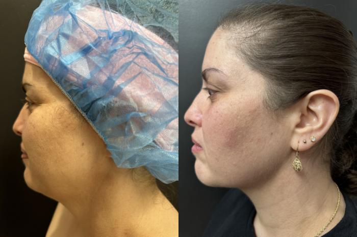 Before minimally invasive neck and lower facelift