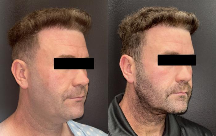 Before photo of man who underwent minimally invasive neck lift procedure with Dr. Armando Soto