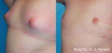 Before & After Bodytite Case 28550 View #1 View in Orlando, FL