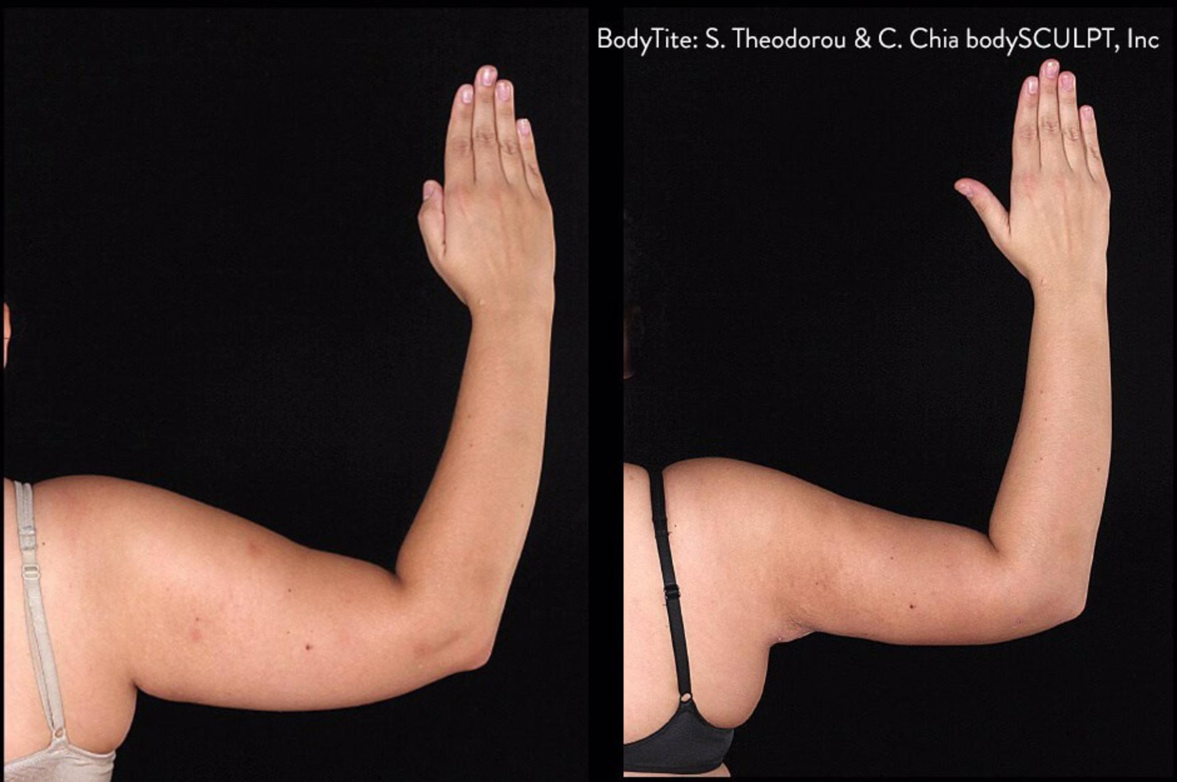 Before & After Bodytite Case 28551 View #1 View in Orlando, FL
