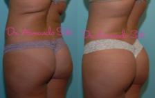 Before & After Brazilian Butt Lift Case 23426 View #1 View in Orlando, FL