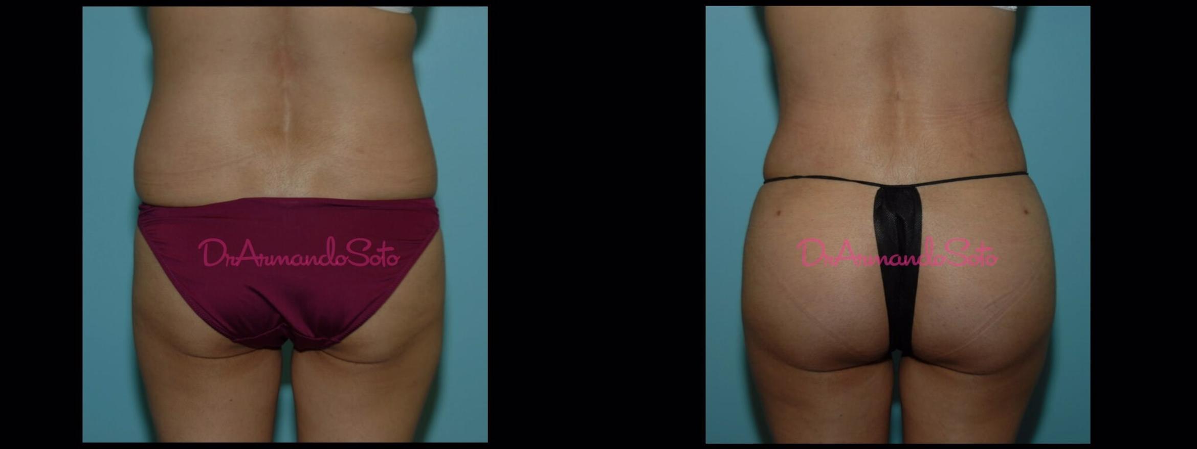 Before & After Brazilian Butt Lift Case 23428 View #1 View in Orlando, FL