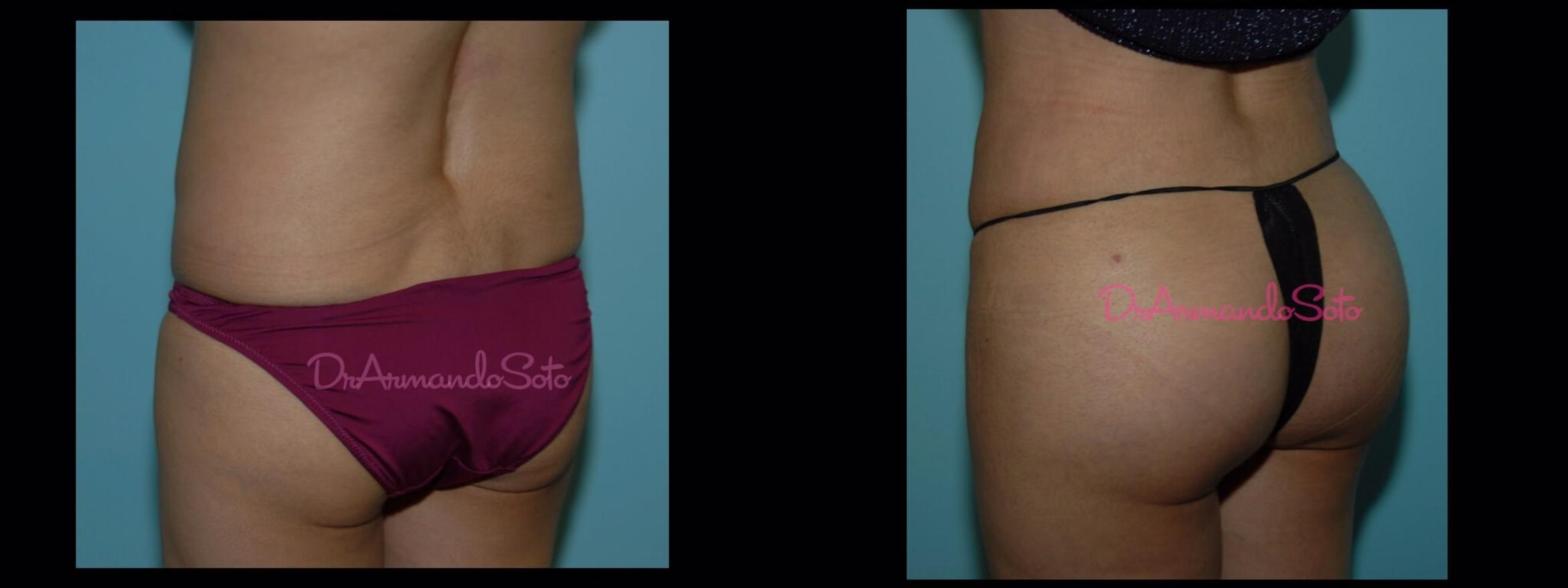 Before & After Brazilian Butt Lift Case 23428 View #2 View in Orlando, FL