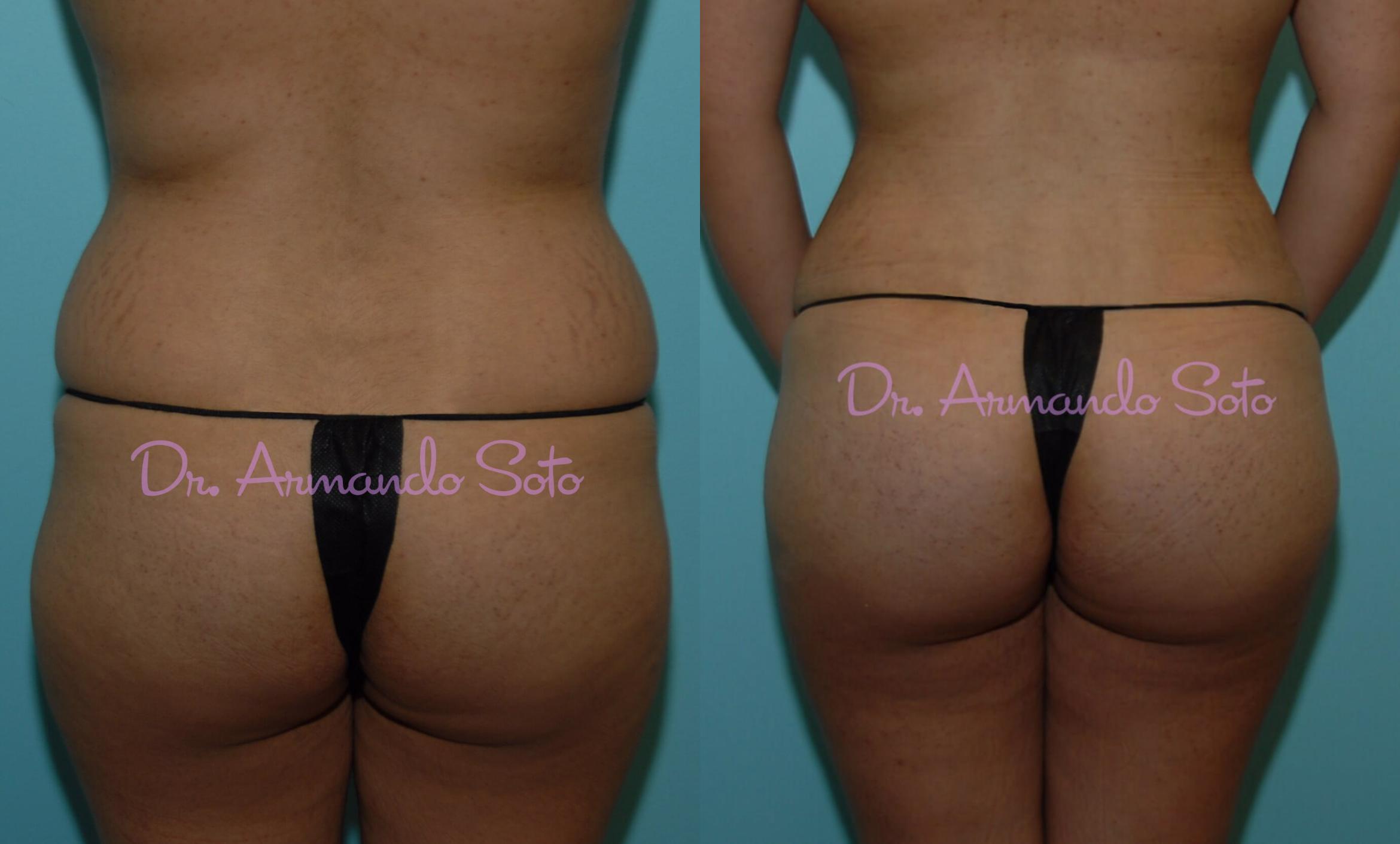 Dr. Baccaro on the Brazilian Butt Lift