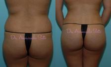 Before & After Brazilian Butt Lift Case 23434 View #1 View in Orlando, FL