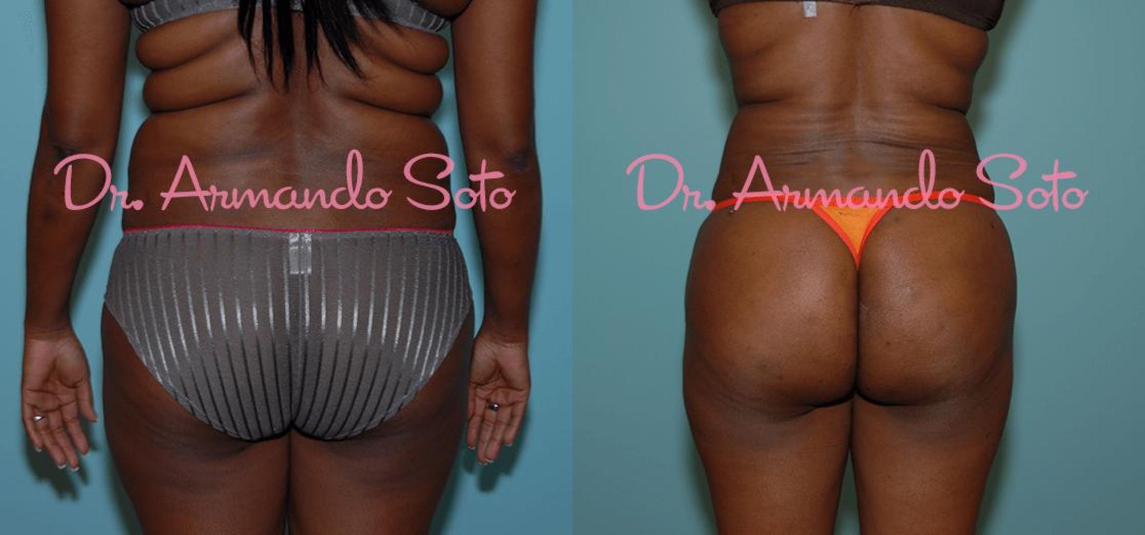 Before & After Brazilian Butt Lift Case 23455 View #1 View in Orlando, FL