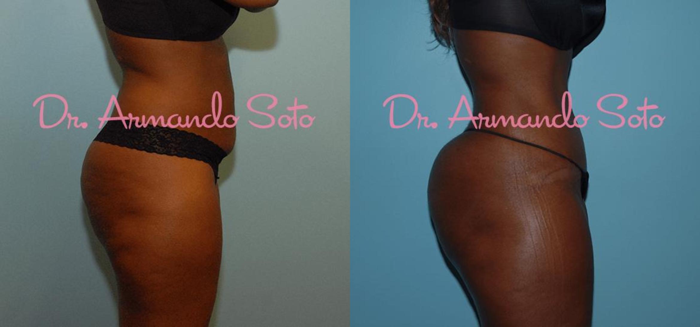 How To Prepare Your Mind & Body Before a Brazilian Butt Lift - Destin  Plastic Surgery Serving Panama City & Pensacola, FL