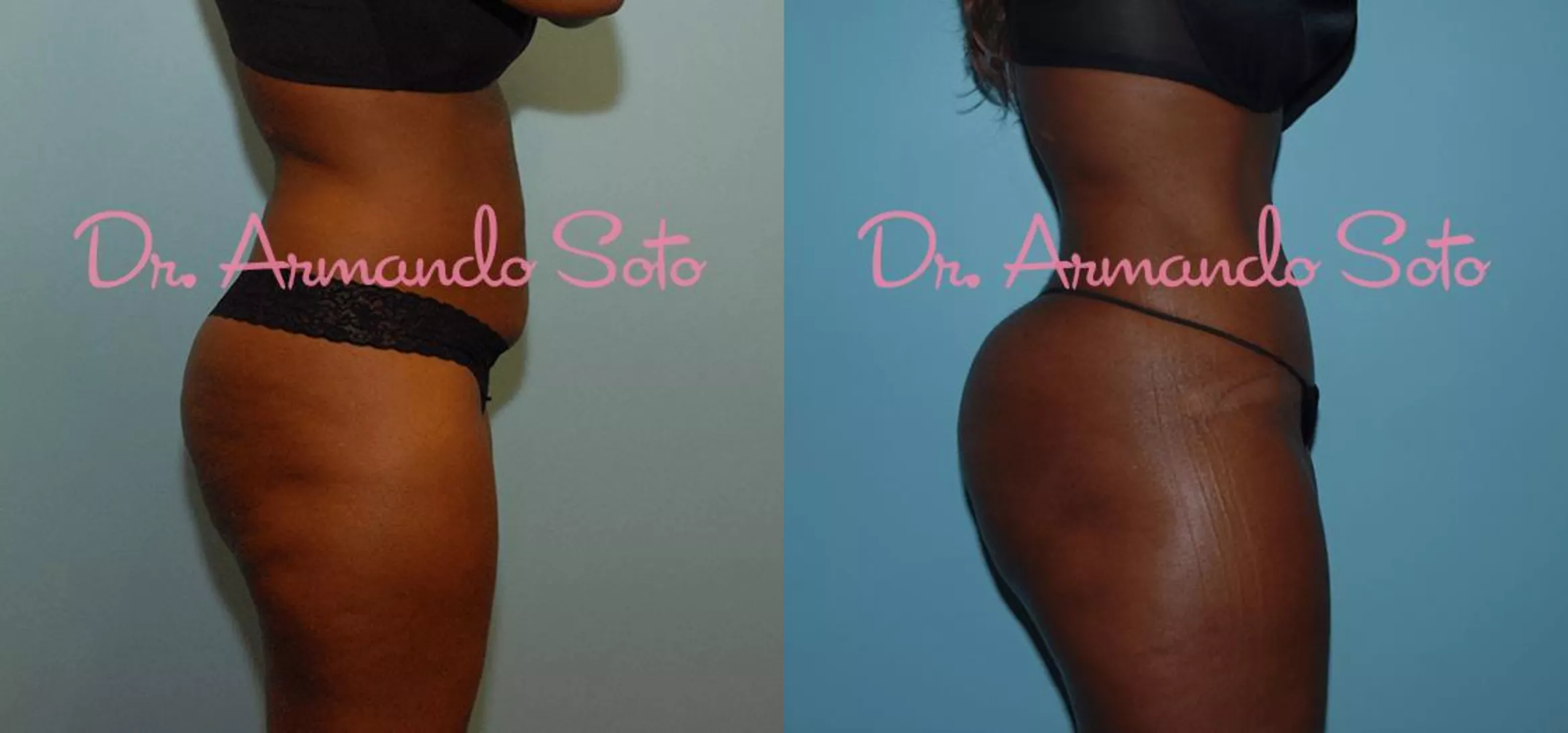 Brazilian Butt Lift Before and After Pictures Case 23456