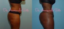 Before & After Brazilian Butt Lift Case 23456 View #1 View in Orlando, FL
