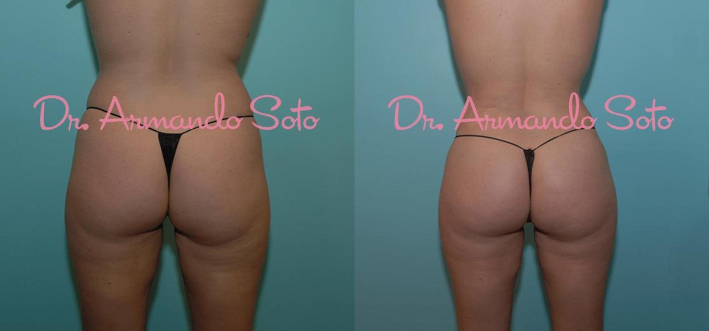 Before & After Brazilian Butt Lift Case 23540 View #1 View in Orlando, FL