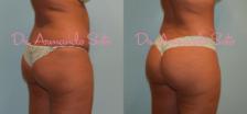 Before & After Brazilian Butt Lift Case 23759 View #1 View in Orlando, FL