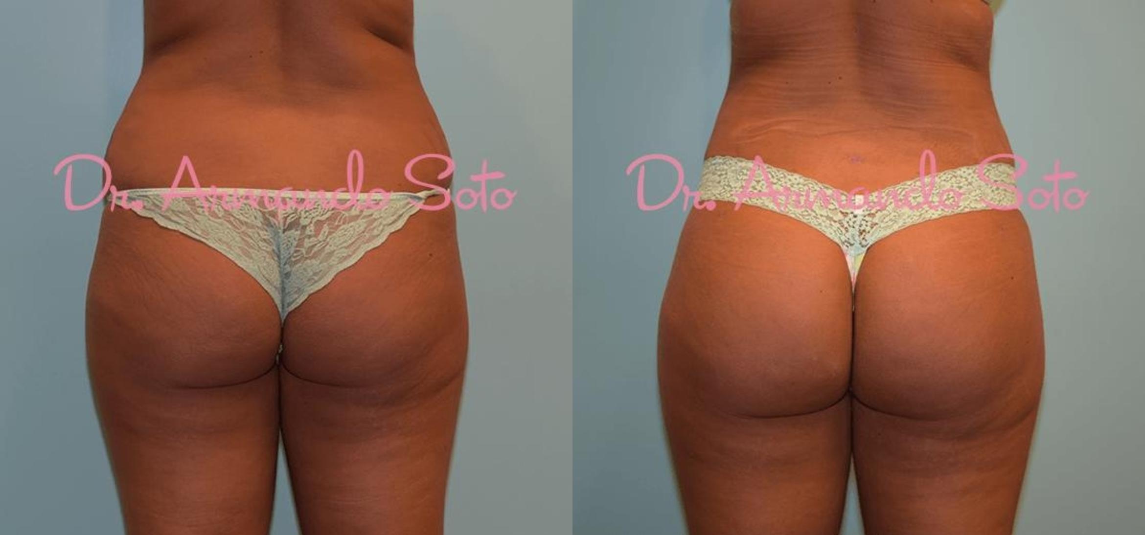 Before & After Brazilian Butt Lift Case 23759 View #2 View in Orlando, FL