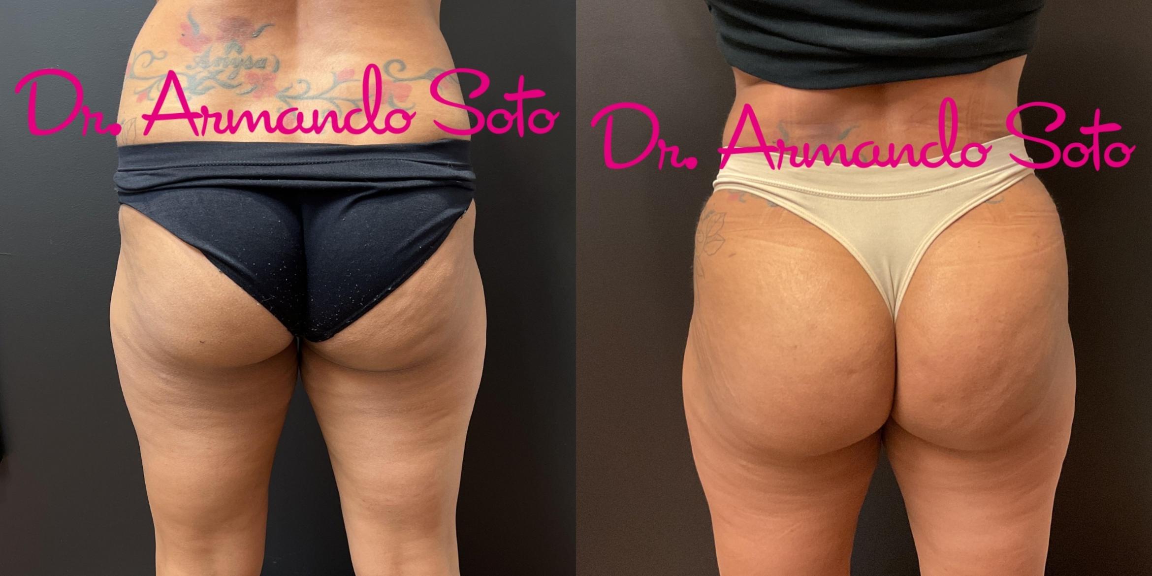 Brazilian Butt Lift Before and After Pictures Case 76274 | Orlando, FL | Aesthetics Enhancements Plastic Surgery and Laser
