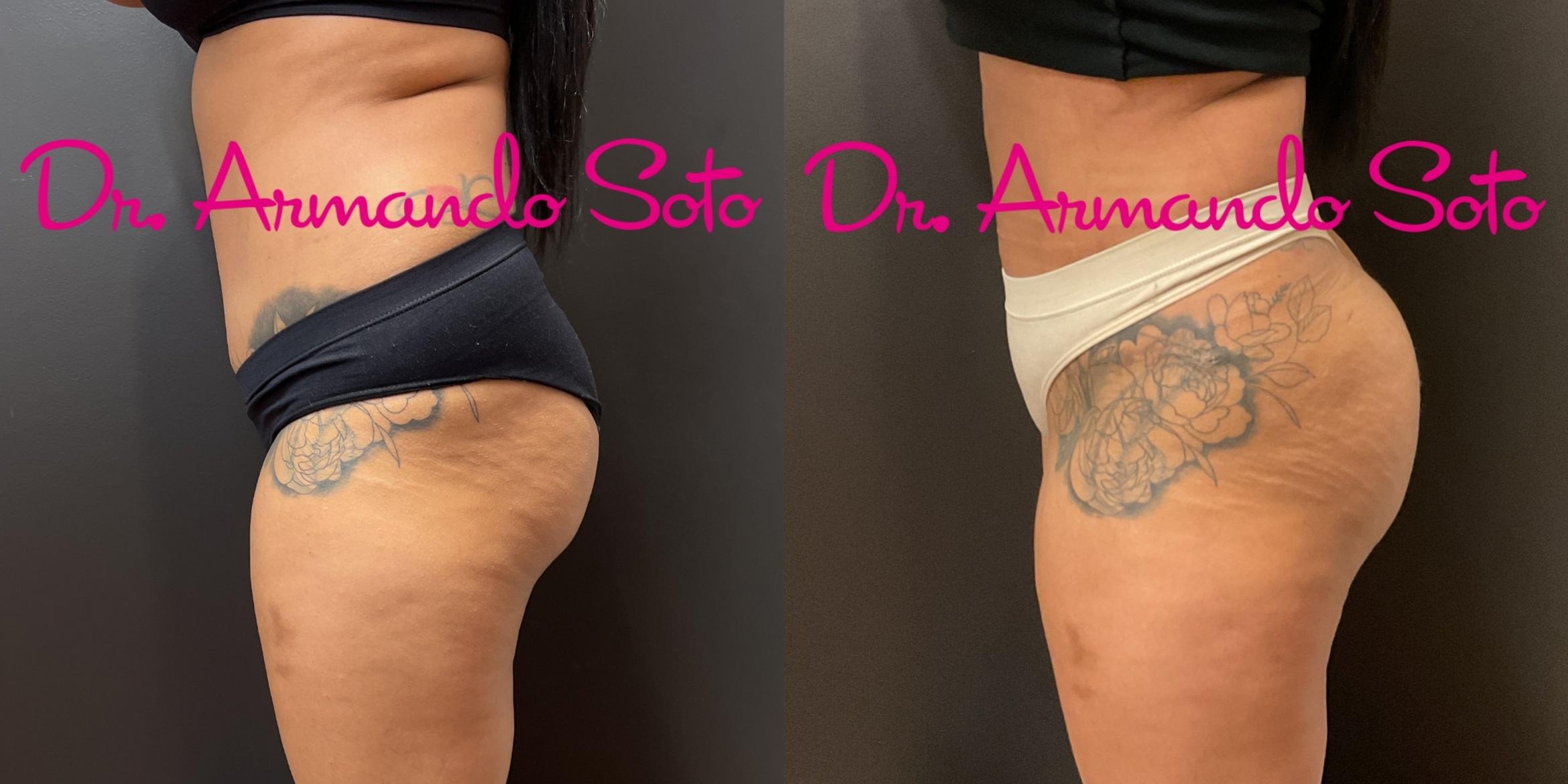 Before & After Brazilian Butt Lift Case 76274 Left Side View in Orlando, FL