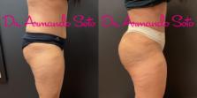 Before & After Brazilian Butt Lift Case 76274 Right Side View in Orlando, FL