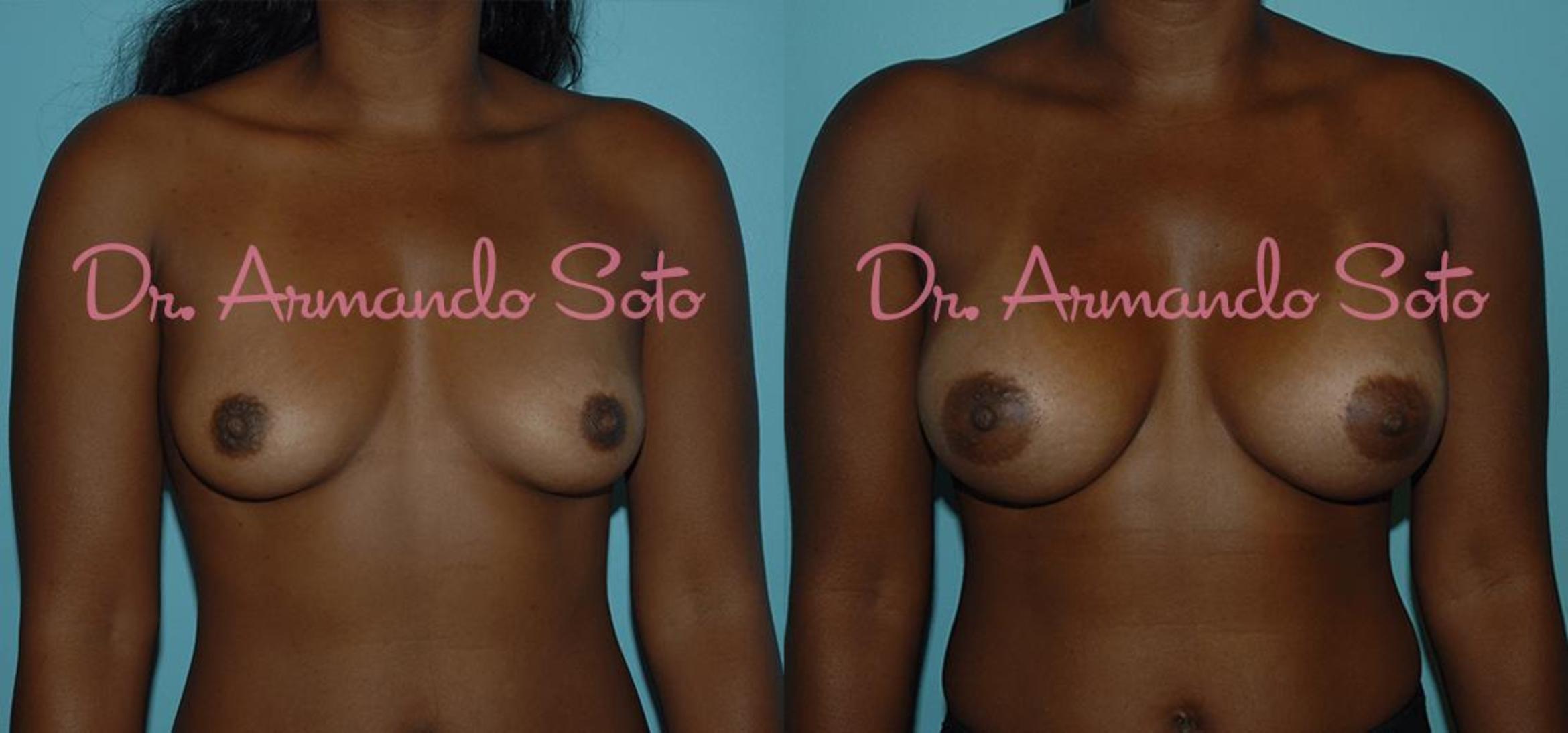 Before & After Breast Augmentation Case 23309 View #1 View in Orlando, FL