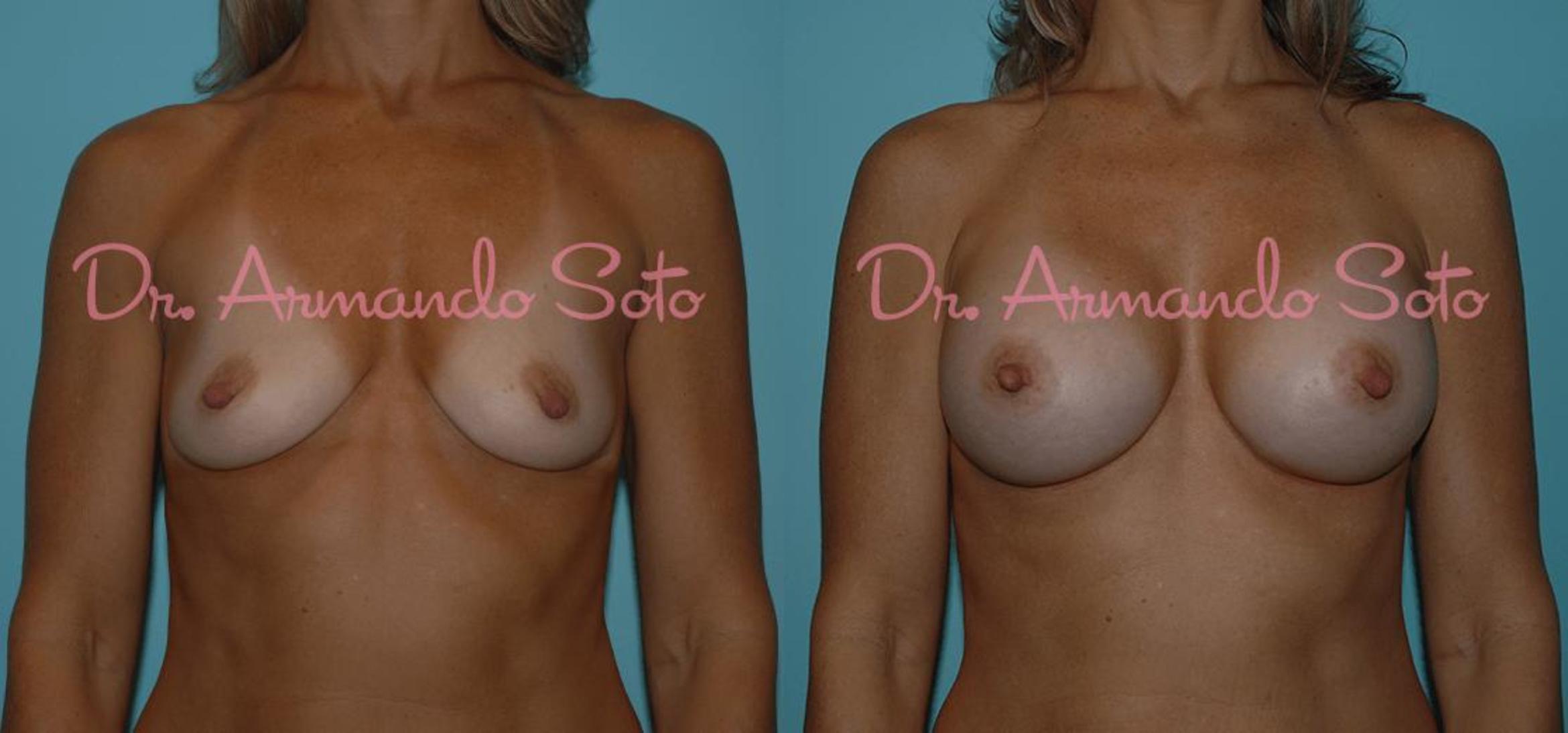 Before & After Breast Augmentation Case 23310 View #1 View in Orlando, FL