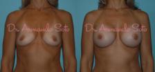 Before & After Breast Augmentation Case 23310 View #1 View in Orlando, FL