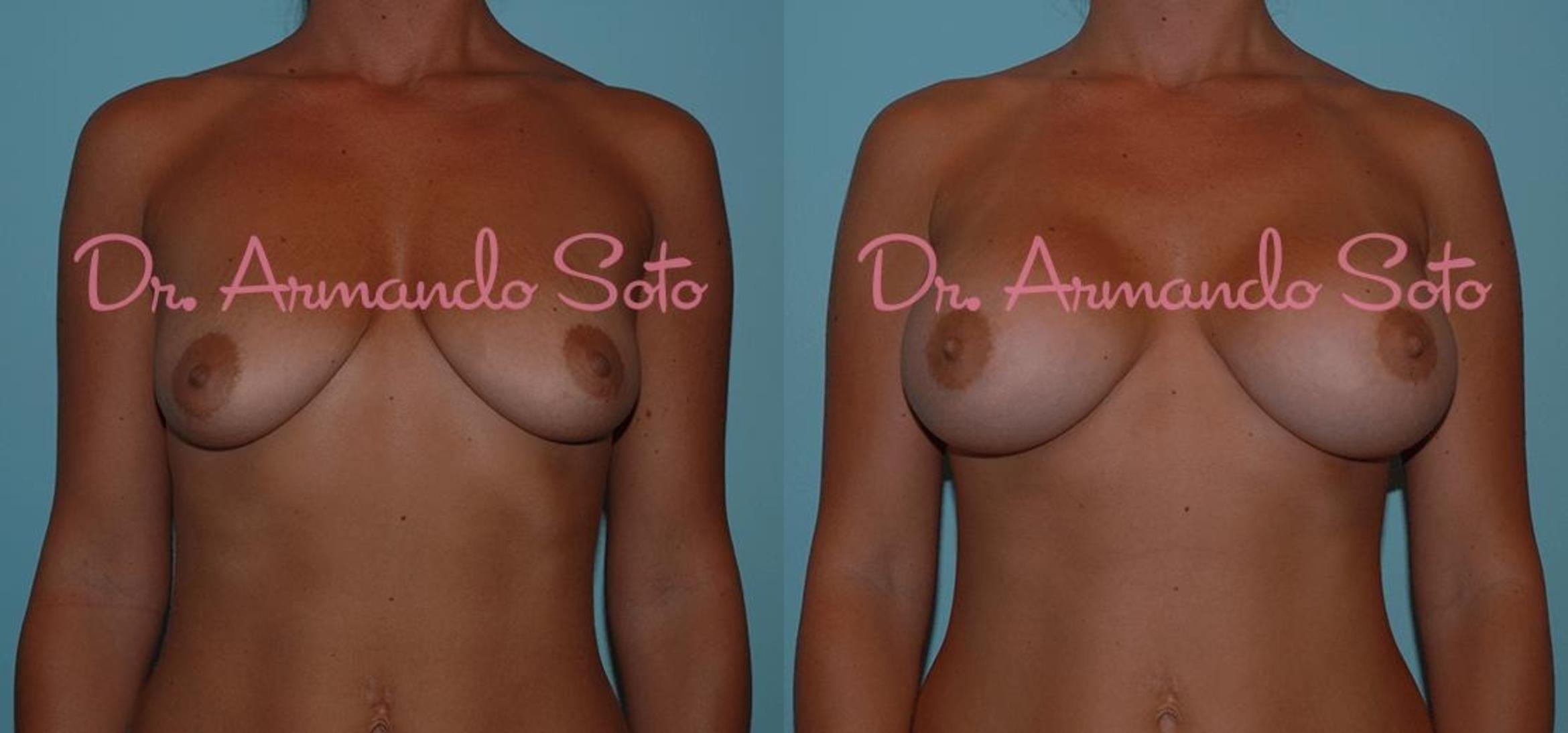 Before & After Breast Augmentation Case 23315 View #1 View in Orlando, FL