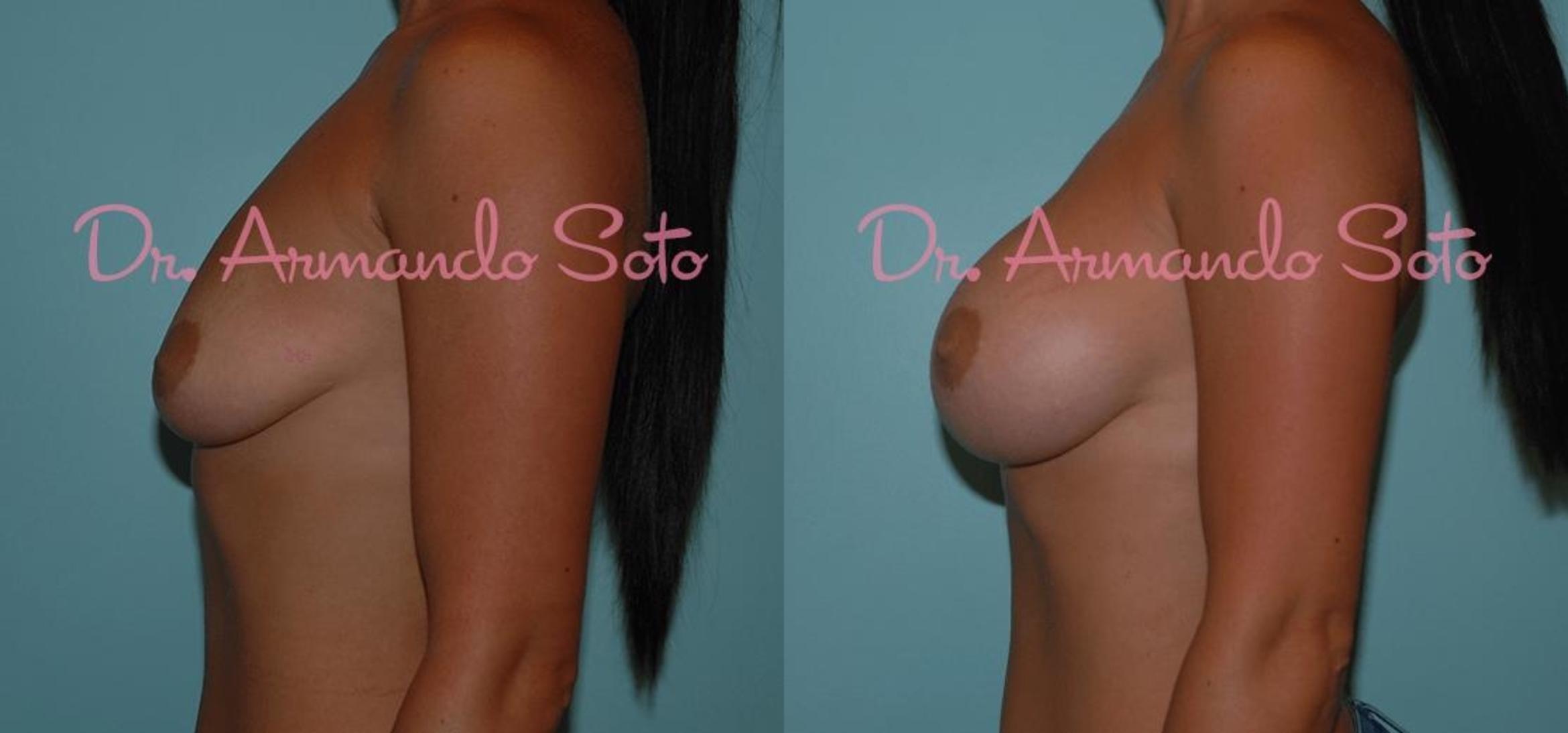 Before & After Breast Augmentation Case 23315 View #2 View in Orlando, FL