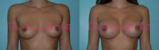 Before & After Breast Augmentation Case 23319 View #1 View in Orlando, FL