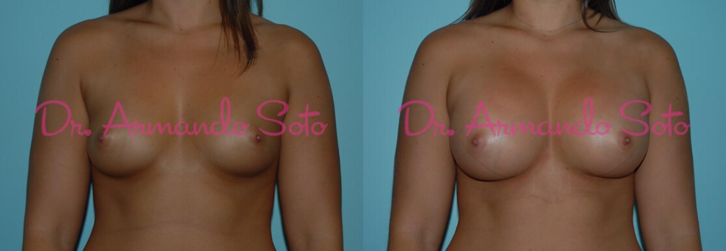 Before & After Breast Augmentation Case 23320 View #1 View in Orlando, FL