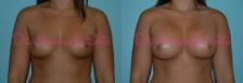 Before & After Breast Augmentation Case 23320 View #1 View in Orlando, FL