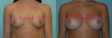 Before & After Breast Augmentation Case 23321 View #1 View in Orlando, FL
