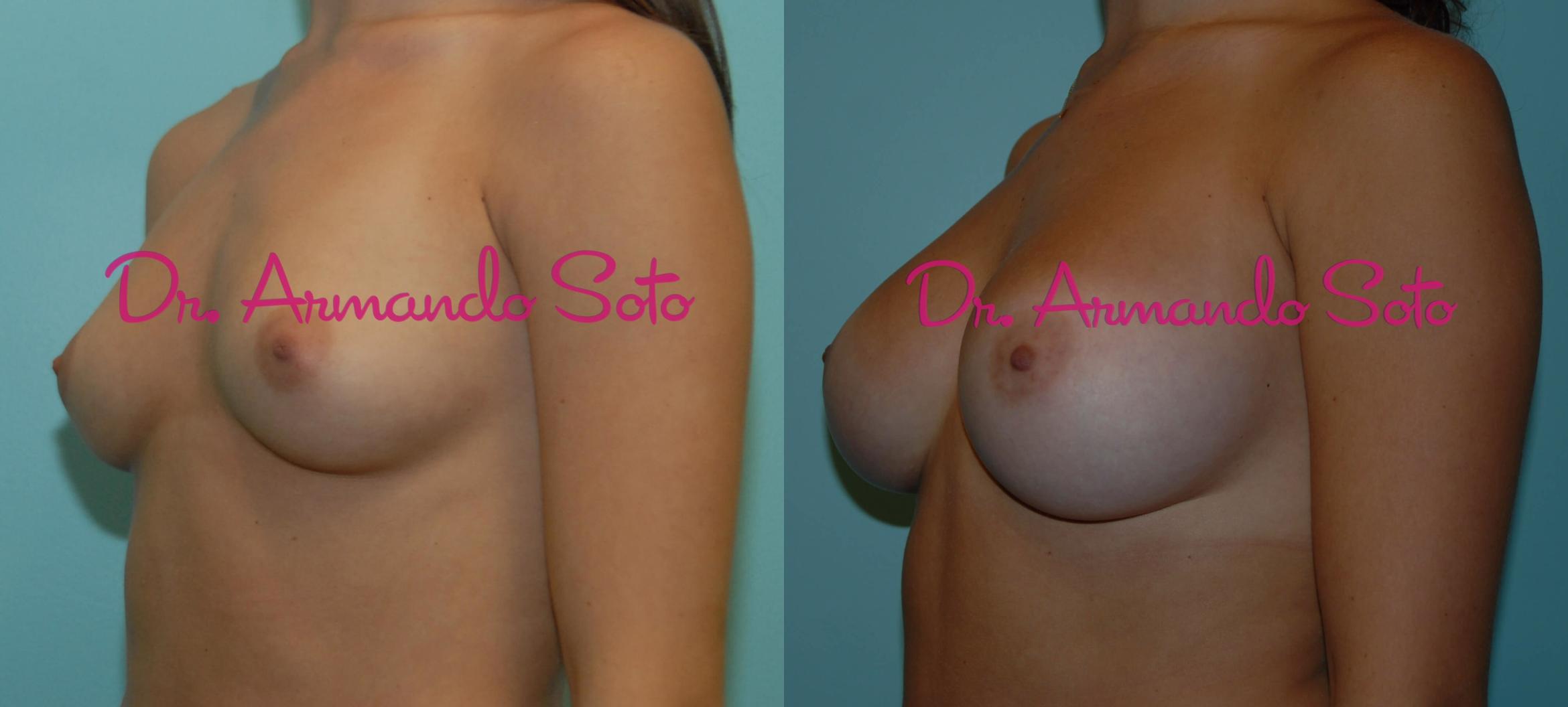 Before & After Breast Augmentation Case 23321 View #2 View in Orlando, FL