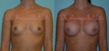 Before & After Breast Augmentation Case 23326 View #1 View in Orlando, FL