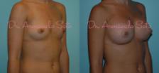 Before & After Breast Augmentation Case 23326 View #2 View in Orlando, FL