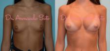 Before & After Breast Augmentation Case 23330 View #1 View in Orlando, FL