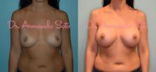 Before & After Breast Augmentation Case 23375 View #1 View in Orlando, FL