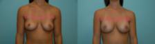 Before & After Breast Augmentation Case 23414 View #1 View in Orlando, FL