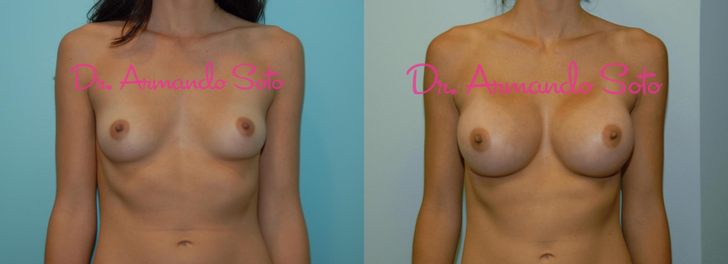 Before & After Breast Augmentation Case 23429 View #1 View in Orlando, FL