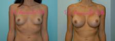 Before & After Breast Augmentation Case 23429 View #1 View in Orlando, FL