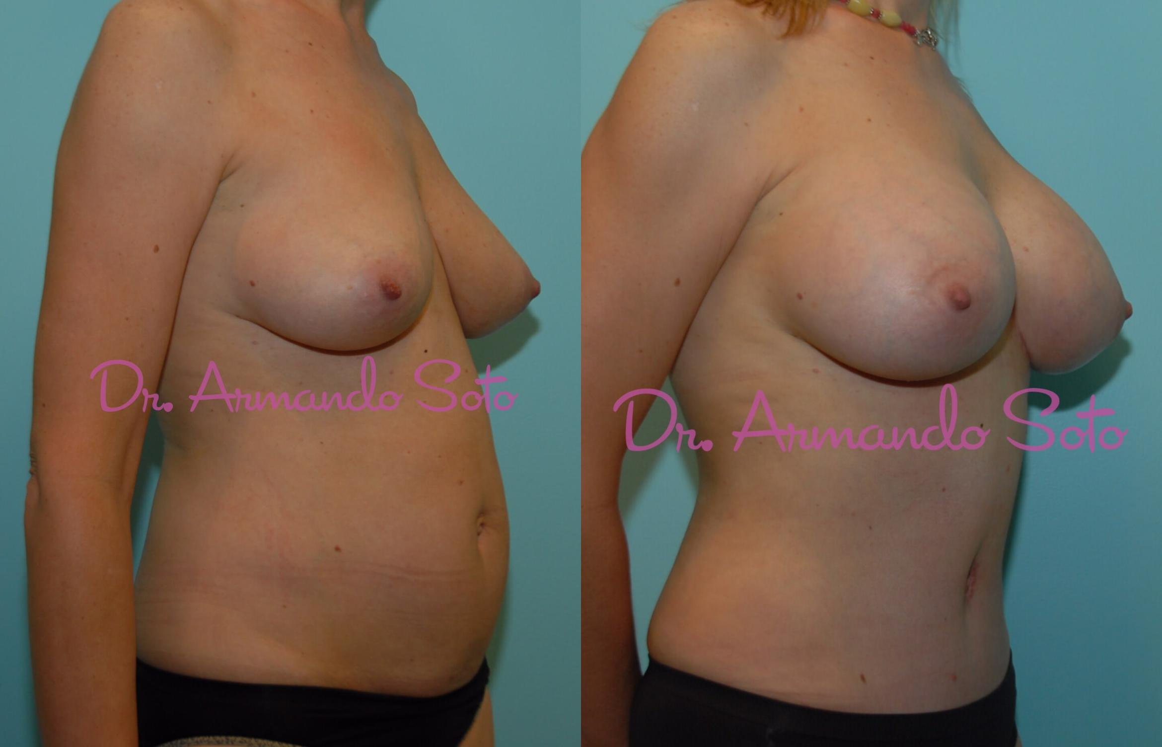 Before & After Breast Augmentation Case 23431 View #1 View in Orlando, FL