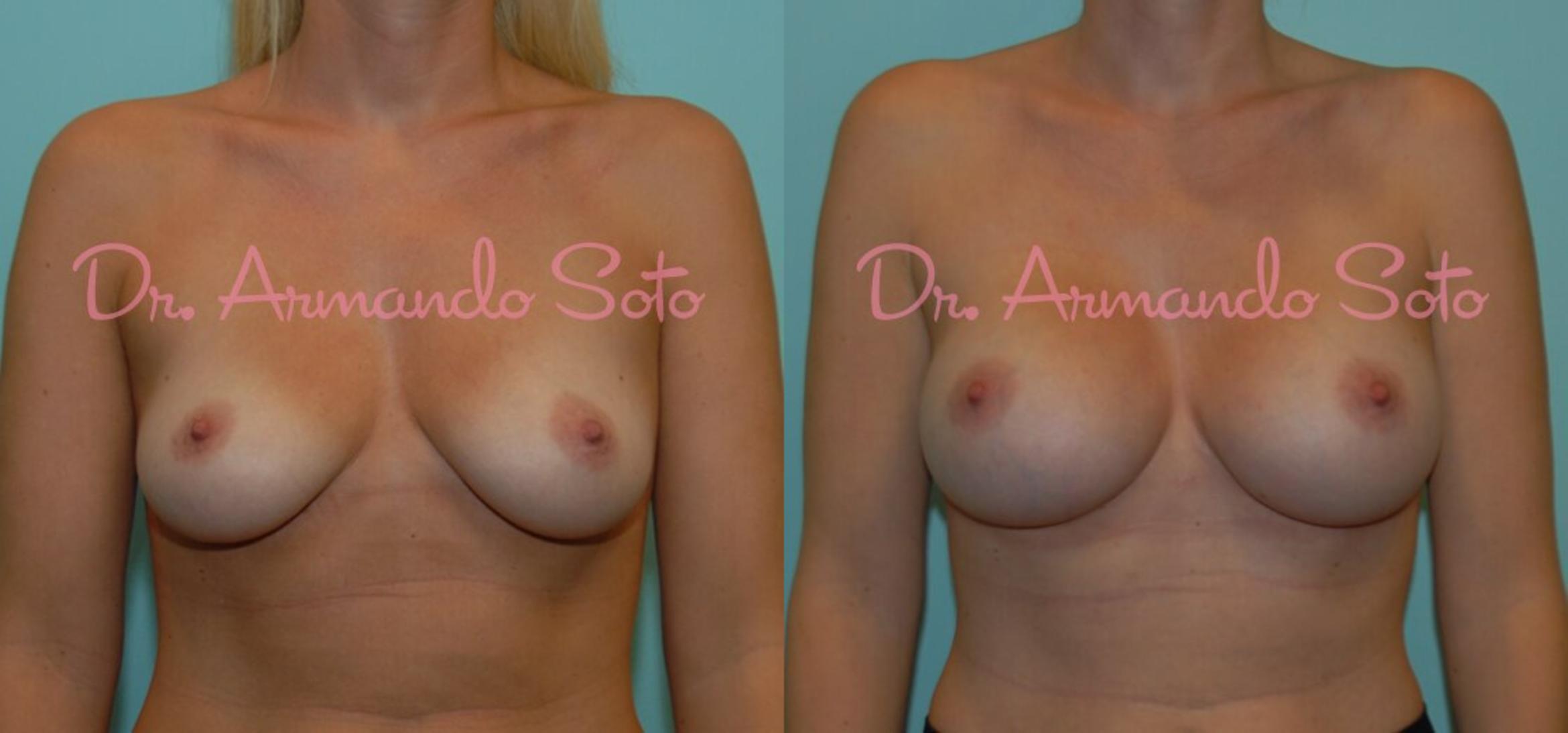 Before & After Breast Augmentation Case 23433 View #1 View in Orlando, FL