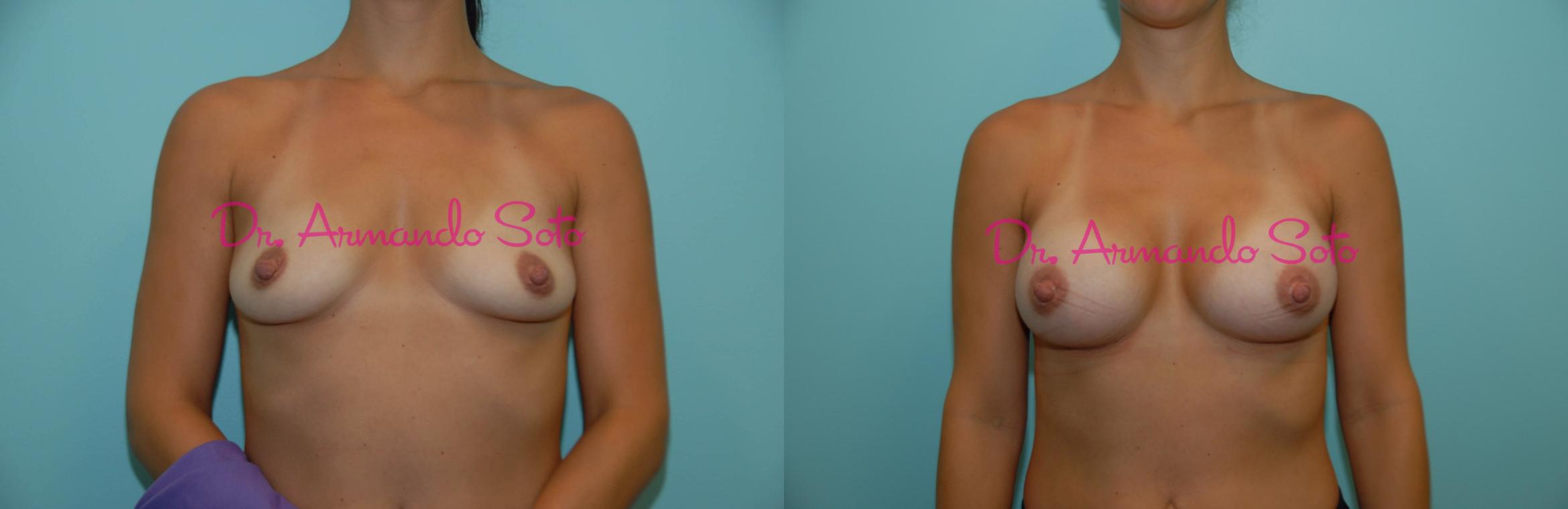 Before & After Breast Augmentation Case 23446 View #1 View in Orlando, FL