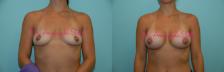 Before & After Breast Augmentation Case 23446 View #1 View in Orlando, FL