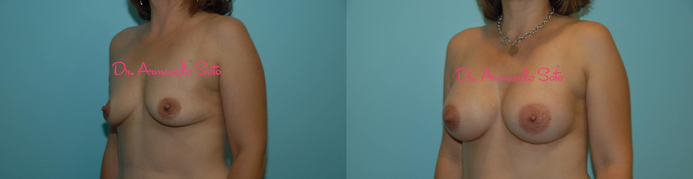 Before & After Breast Augmentation Case 23474 View #1 View in Orlando, FL