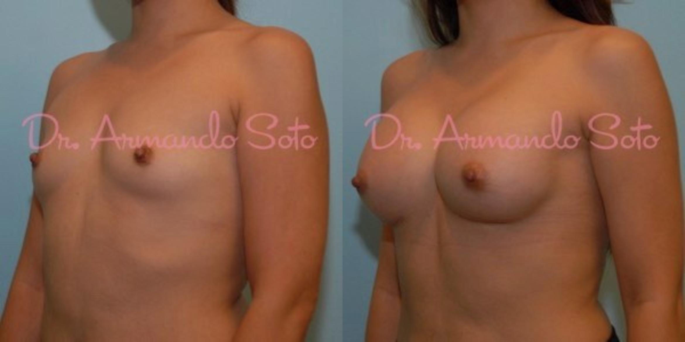 Before & After Breast Augmentation Case 23475 View #1 View in Orlando, FL