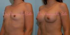 Before & After Breast Augmentation Case 23475 View #1 View in Orlando, FL