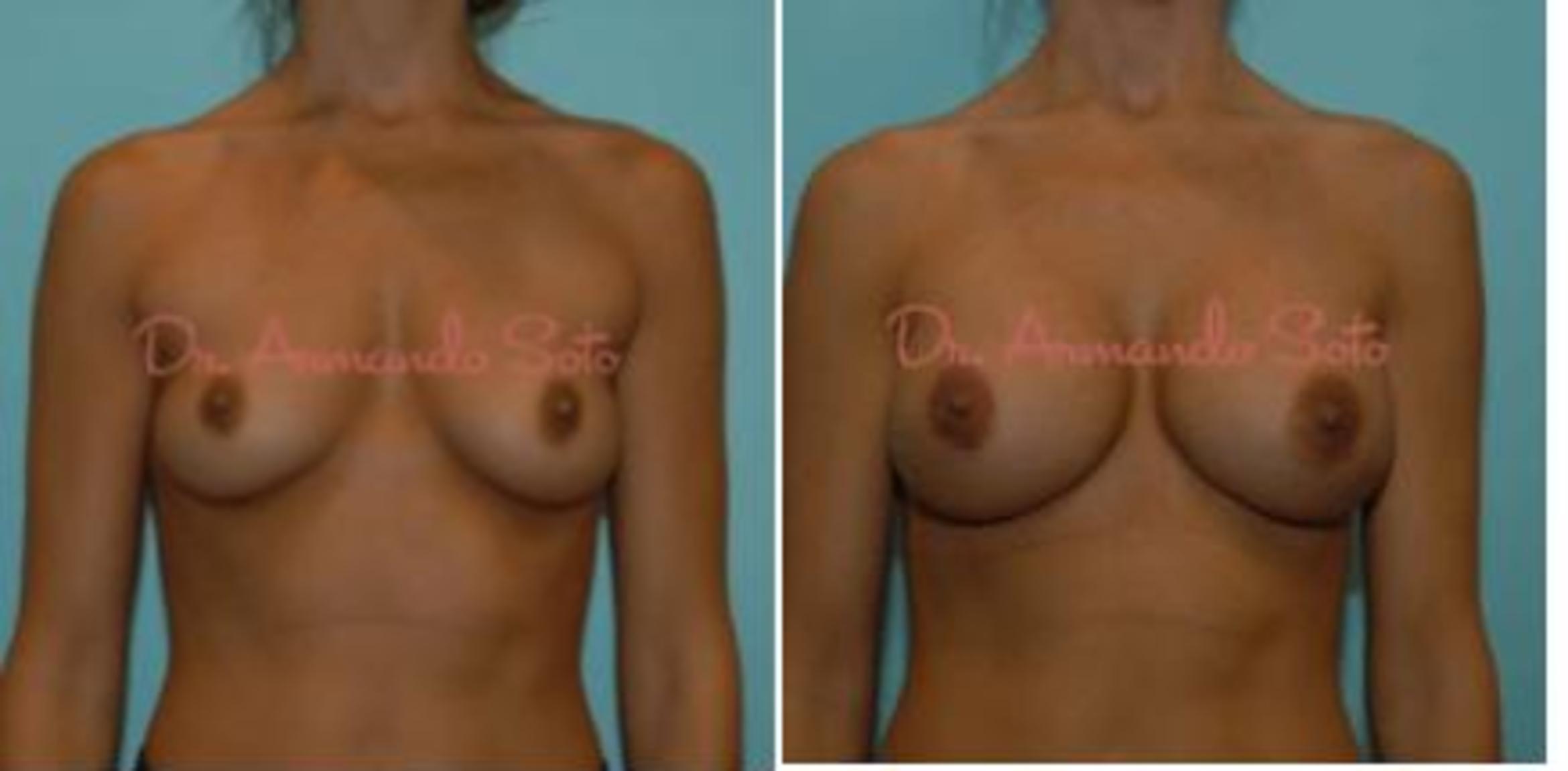 Before & After Breast Augmentation Case 23477 View #1 View in Orlando, FL