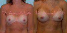 Before & After Breast Augmentation Case 23479 View #1 View in Orlando, FL