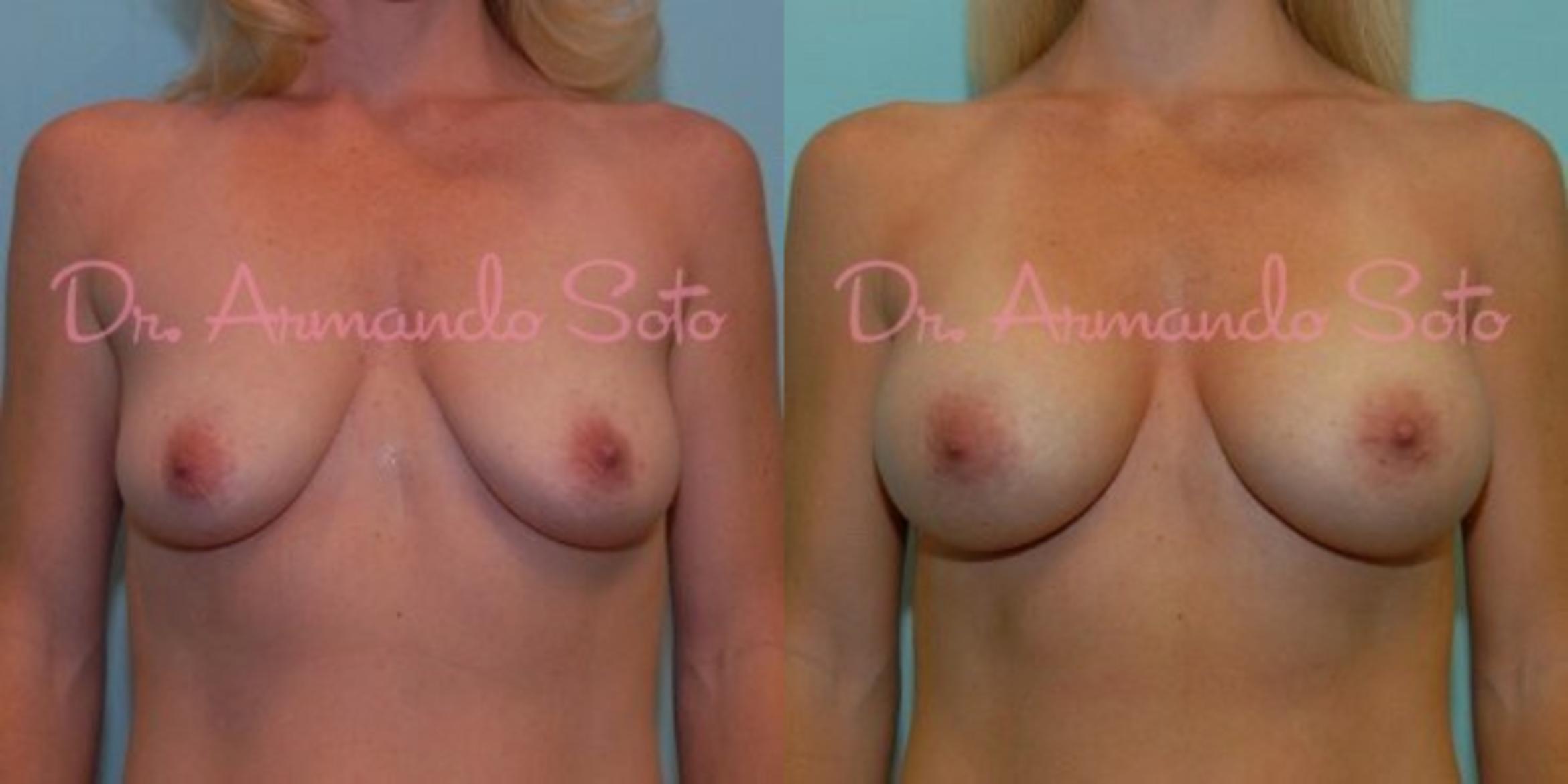 Before & After Breast Augmentation Case 23480 View #1 View in Orlando, FL
