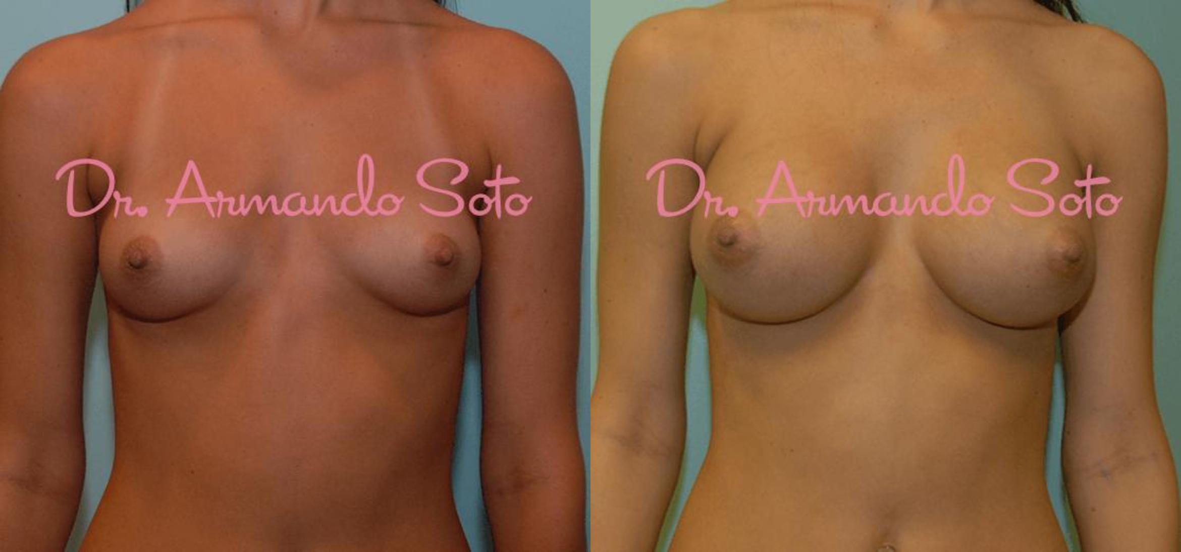 Before & After Breast Augmentation Case 23482 View #1 View in Orlando, FL