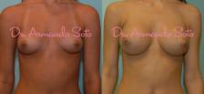 Before & After Breast Augmentation Case 23482 View #1 View in Orlando, FL