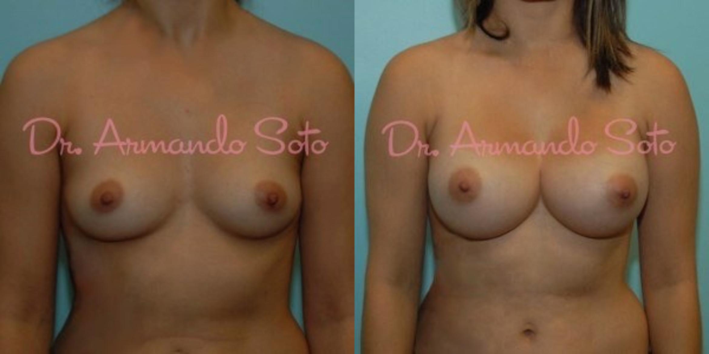 Before & After Breast Augmentation Case 23483 View #1 View in Orlando, FL